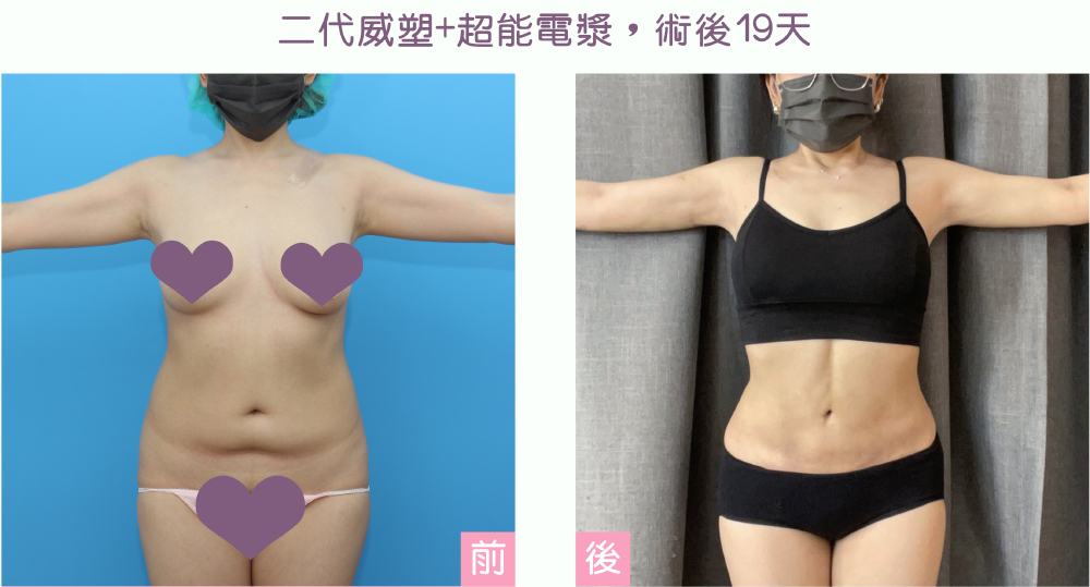 超能電漿+威塑二代抽脂腹部術後案例,19天