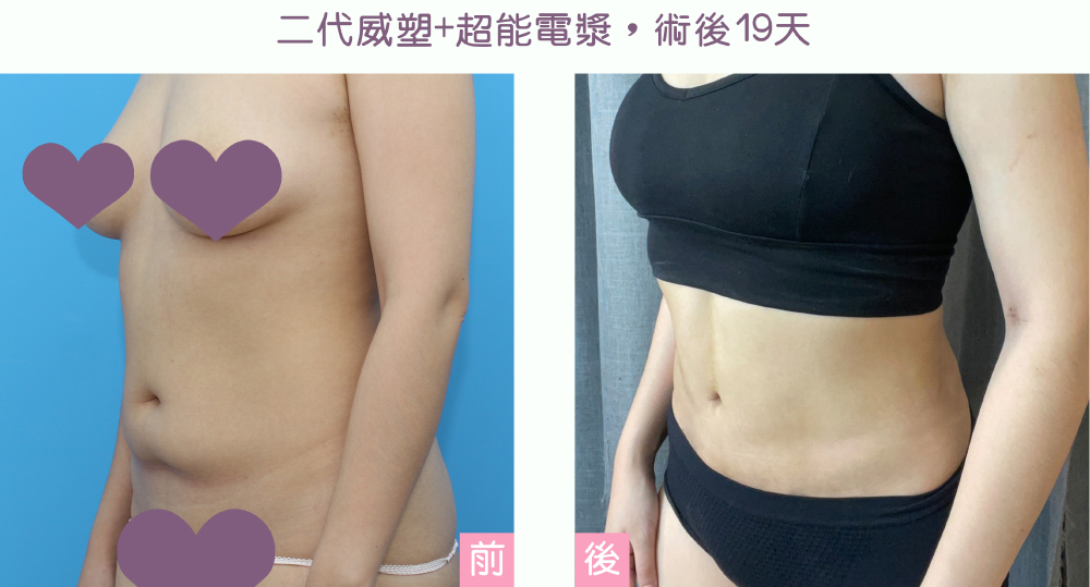 超能電漿+威塑2.2 腹部還抽術後19天,李兆祥醫師案例