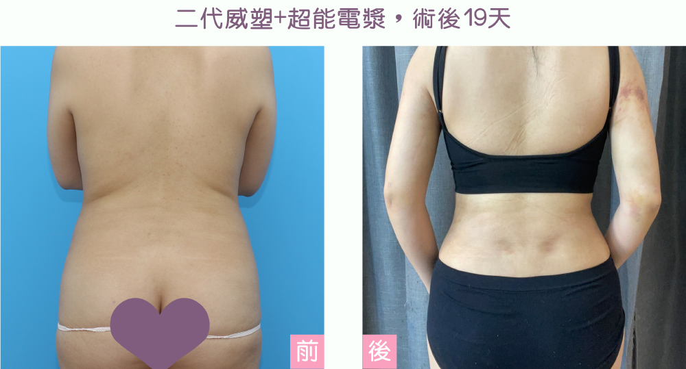 超能電漿Renuvion+二代威塑抽脂Vaser2.2 術後案例,李兆祥醫師