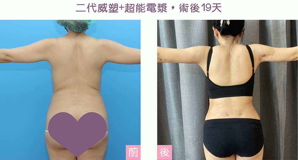 超能電漿+威塑二代,後腰腹部手臂術後案例,人造腰窩,李兆翔醫師