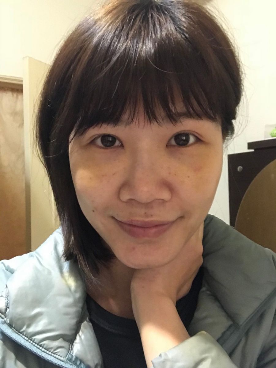 內開眼袋手術+補脂術後第五天