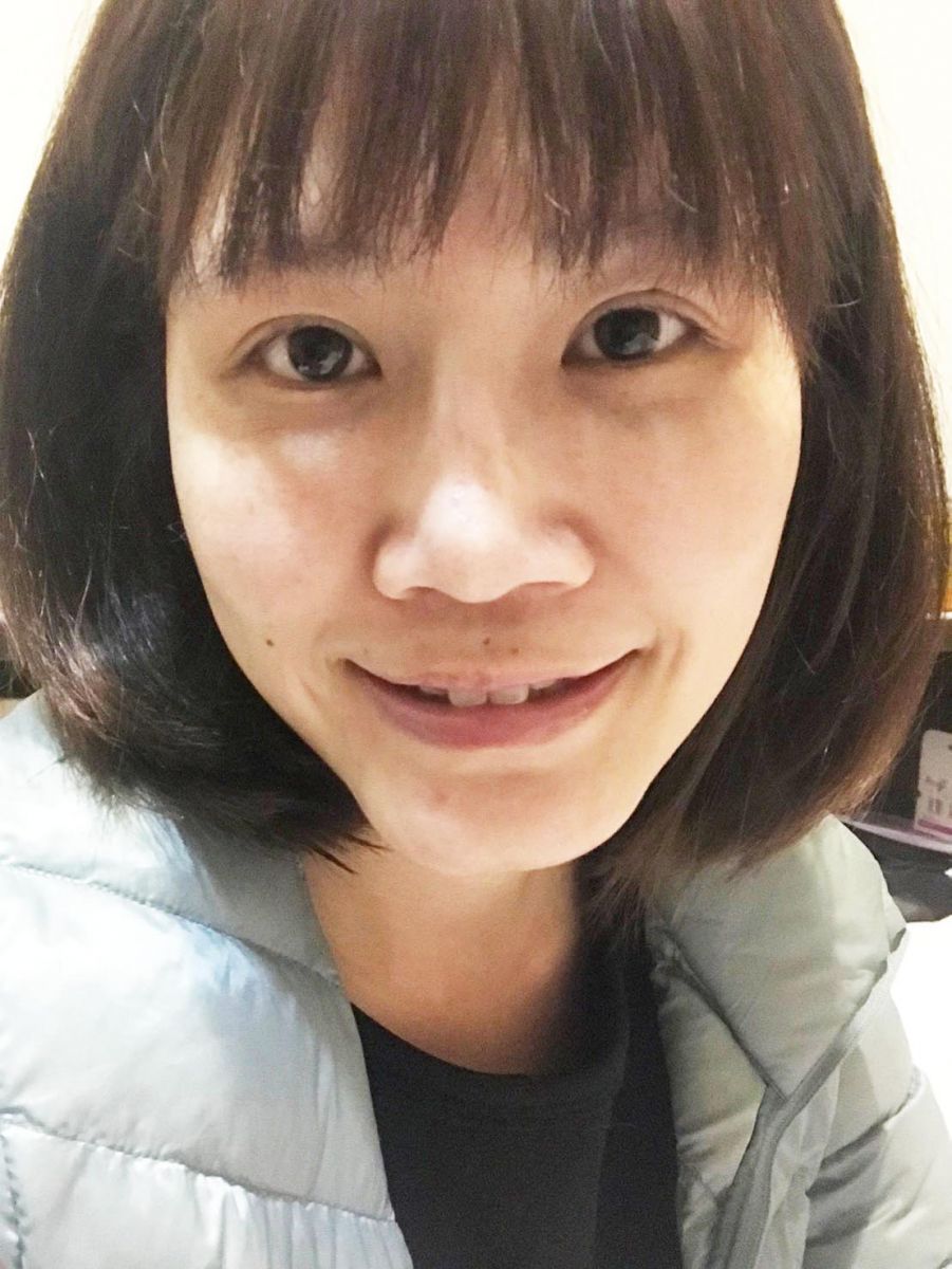 內開眼袋手術+補脂術後第十天