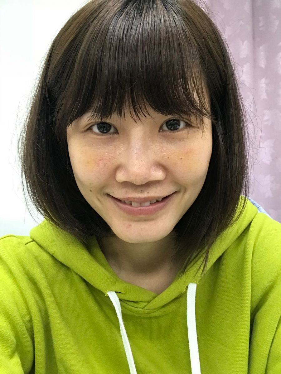 內開眼袋手術+補脂術後第七天