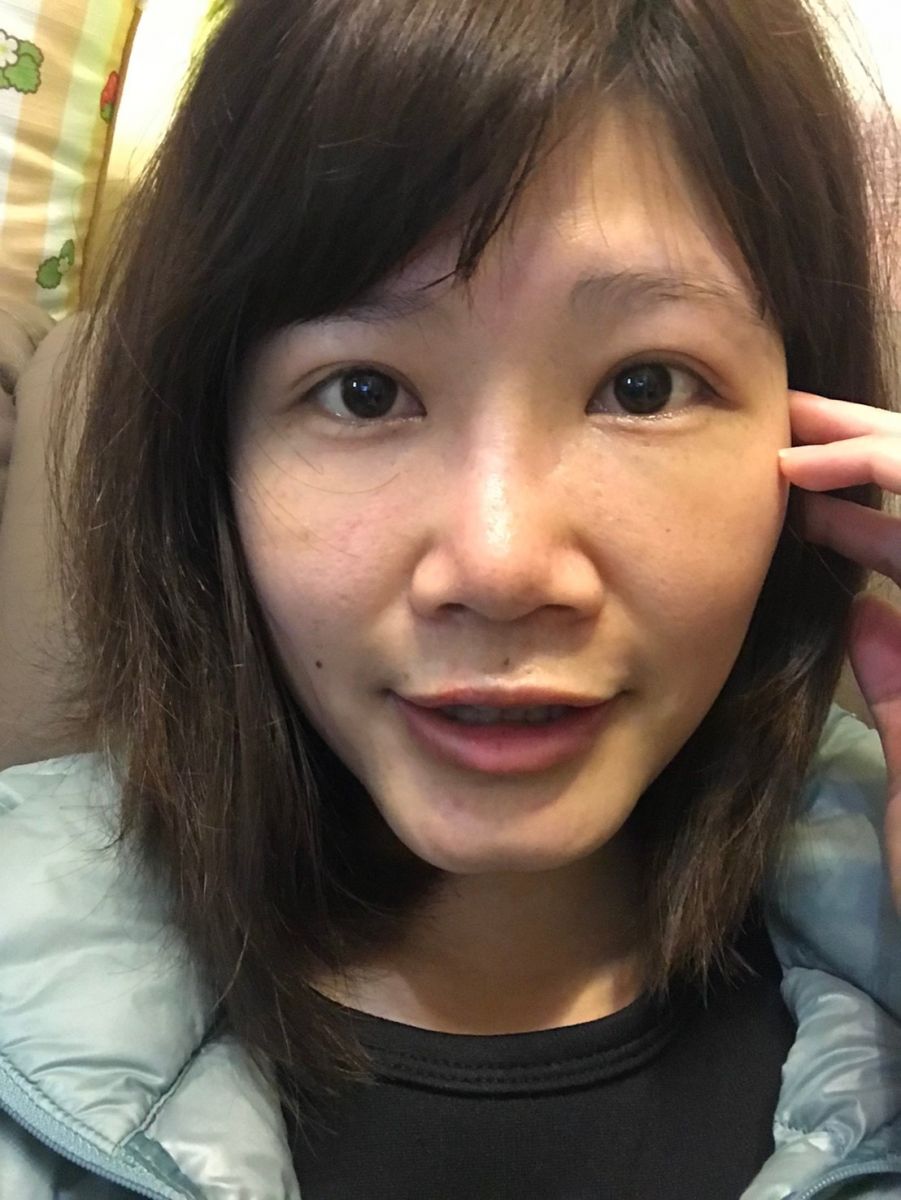 內開眼袋手術+補脂術後第四天