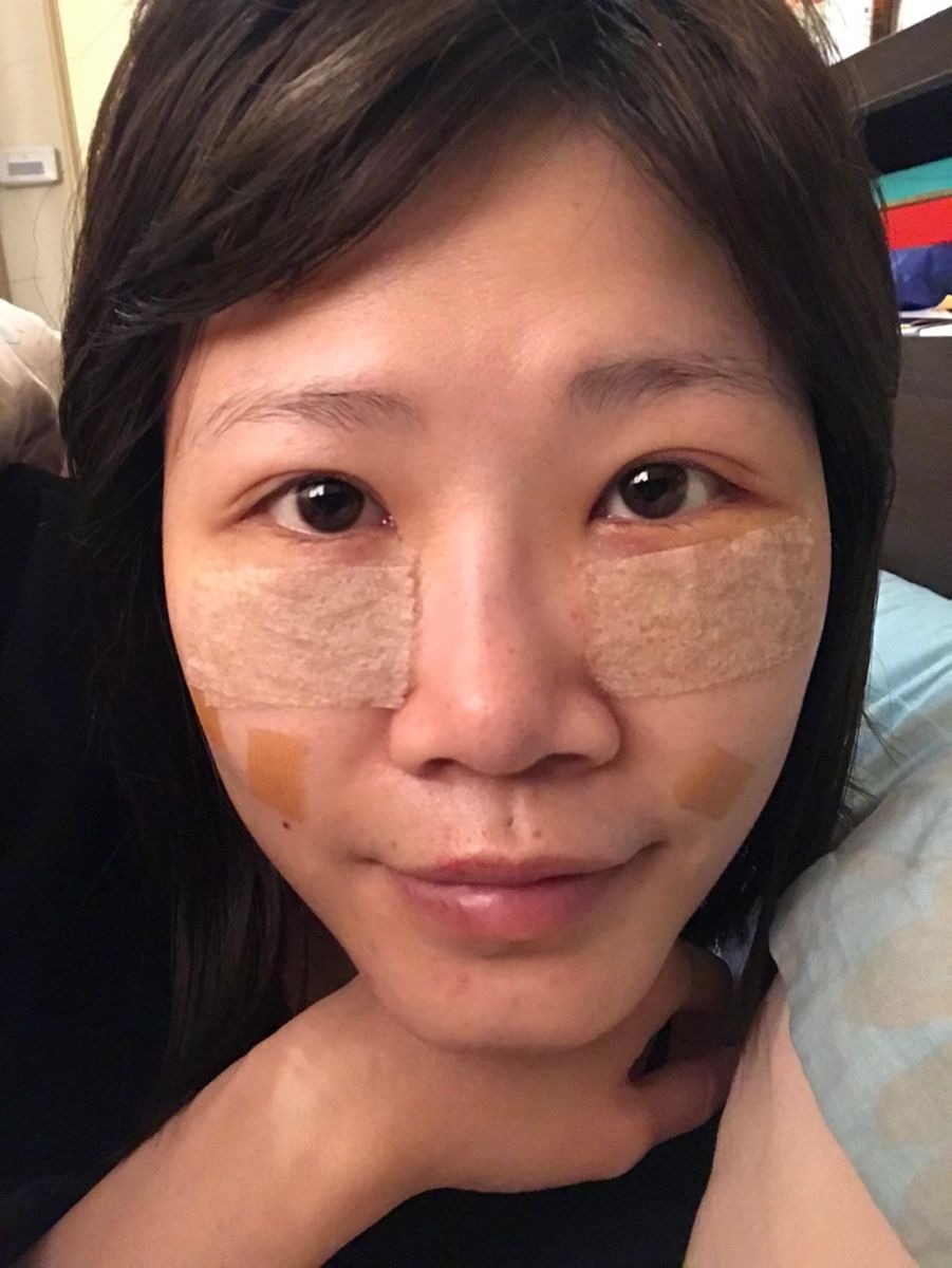 內開眼袋手術+補脂術後第二天