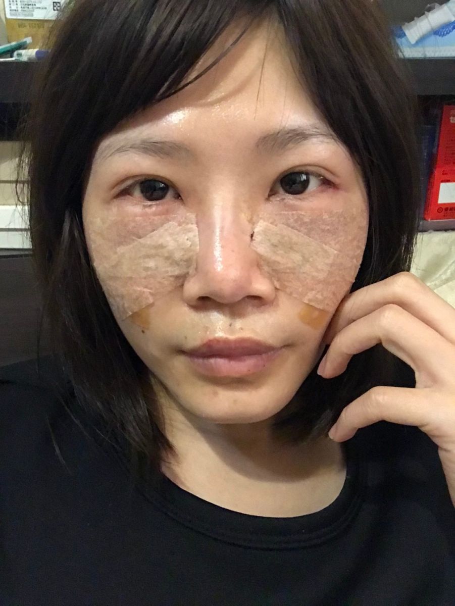 內開眼袋手術+補脂術後第一天