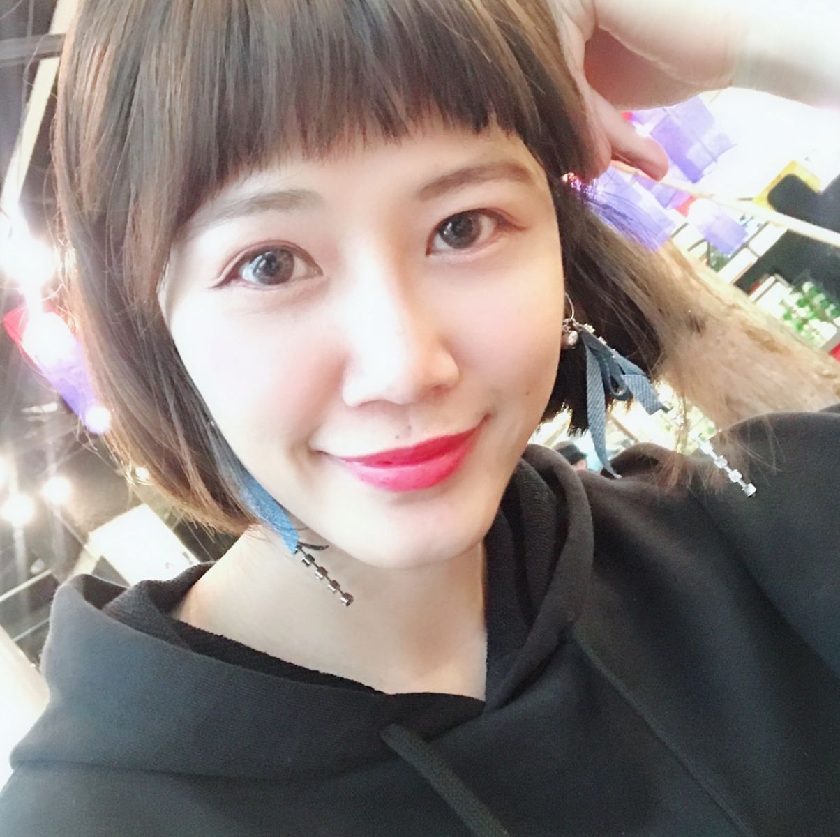 內開眼袋合併自體脂肪補脂術後案例