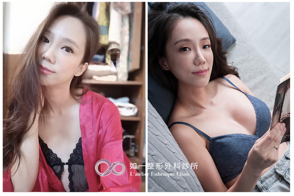 如一診所(原台北新聖)魔滴隆乳案例