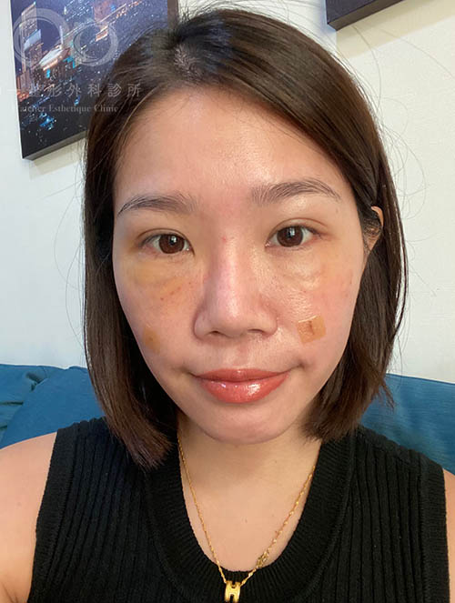 如一診所,蕭奕君醫師,眼袋內開,自體脂肪填脂,威萃,淚溝補脂,蘋果肌補脂