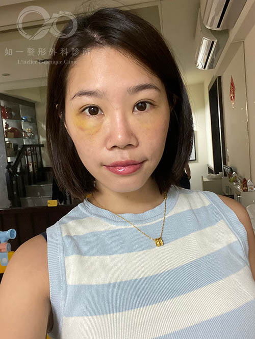 如一診所,蕭奕君醫師,眼袋內開,自體脂肪填脂,威萃,淚溝補脂,蘋果肌補脂