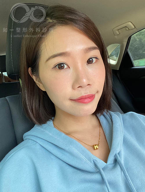 如一診所,蕭奕君醫師,眼袋內開,自體脂肪填脂,威萃,淚溝補脂,蘋果肌補脂