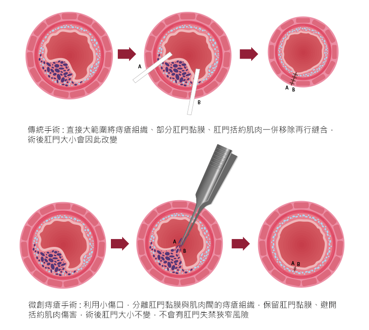 傳統痔瘡手術 VS 微創痔瘡手術 示意圖 鍾雲霓醫師 如一診所