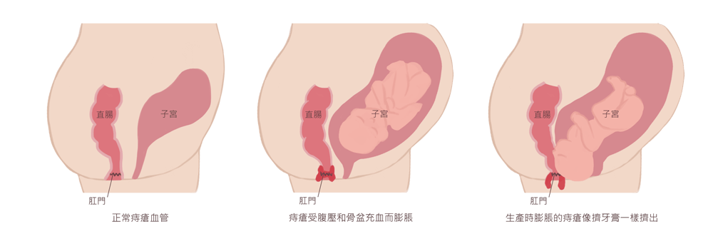 孕期中的痔瘡變化