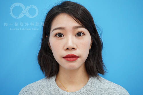 如一診所,眼袋內開,威萃補脂,自體脂肪補蘋果肌,蕭奕君醫師案例