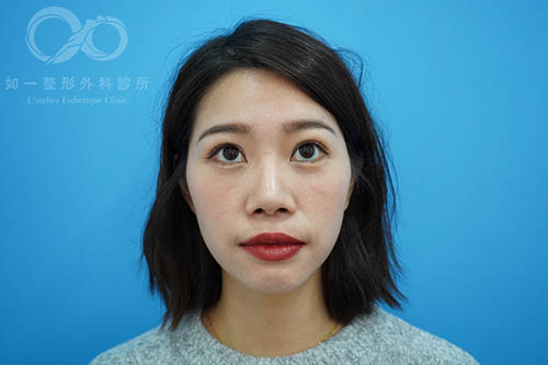 如一診所,眼袋內開,威萃補脂,自體脂肪補蘋果肌,蕭奕君醫師案例