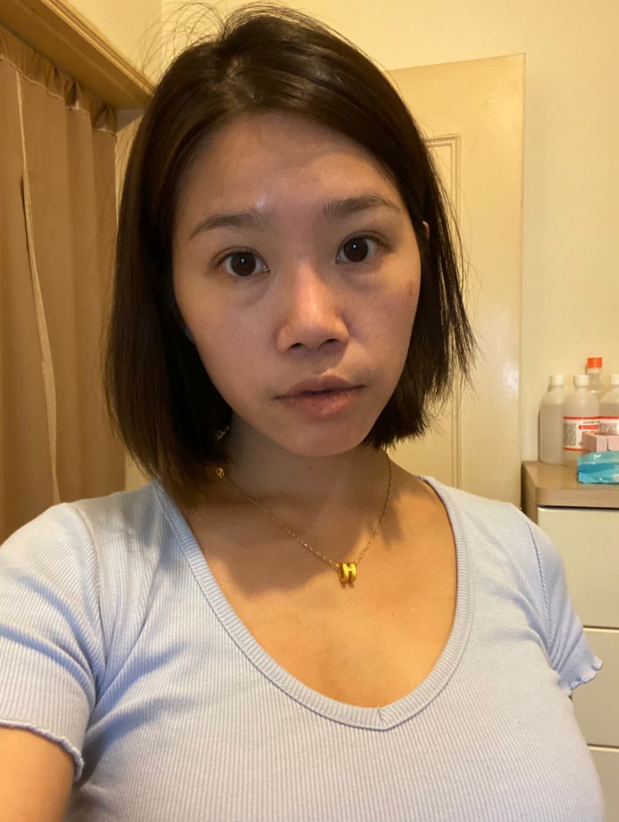 眼袋術前生活照,如一診所,蕭奕君,威萃