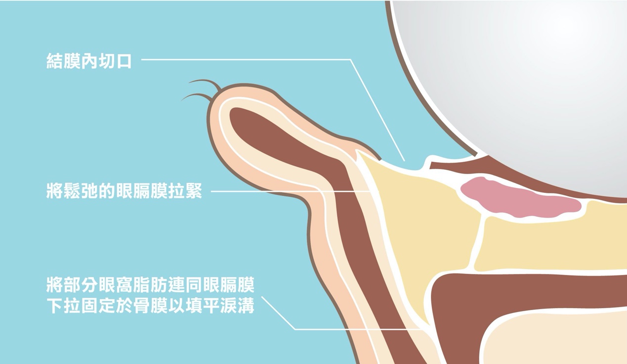 眼袋形成