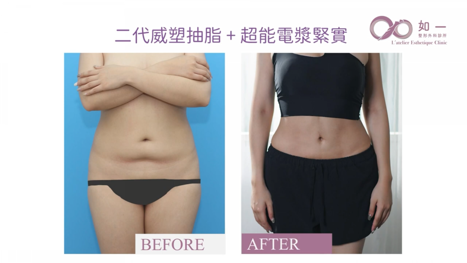 如一診所 李兆翔醫師 威塑抽脂 超能電漿