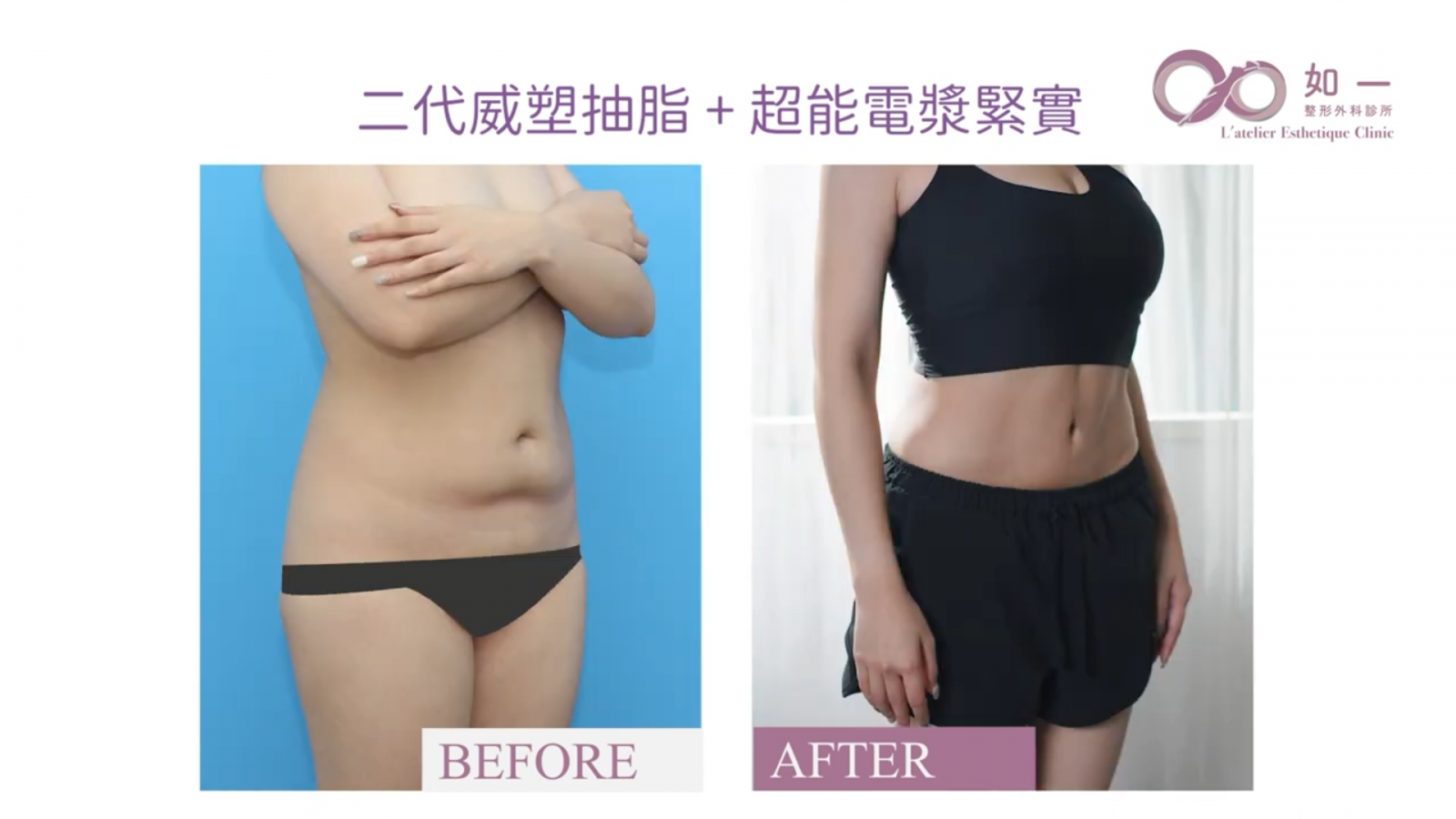 如一診所 李兆翔醫師 威塑抽脂 超能電漿