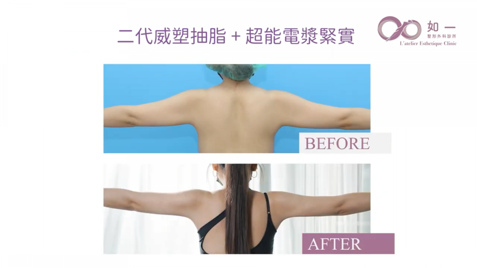 如一診所 李兆翔醫師 威塑抽脂 超能電漿