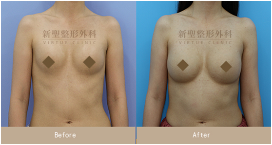 鹽水袋隆乳二次隆乳重修重建重做