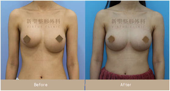 單側隆乳莢膜攣縮二次隆乳重修重建重做