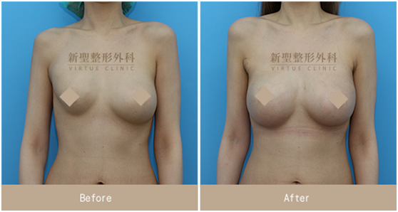 二次隆乳重修重建重做水滴型隆乳