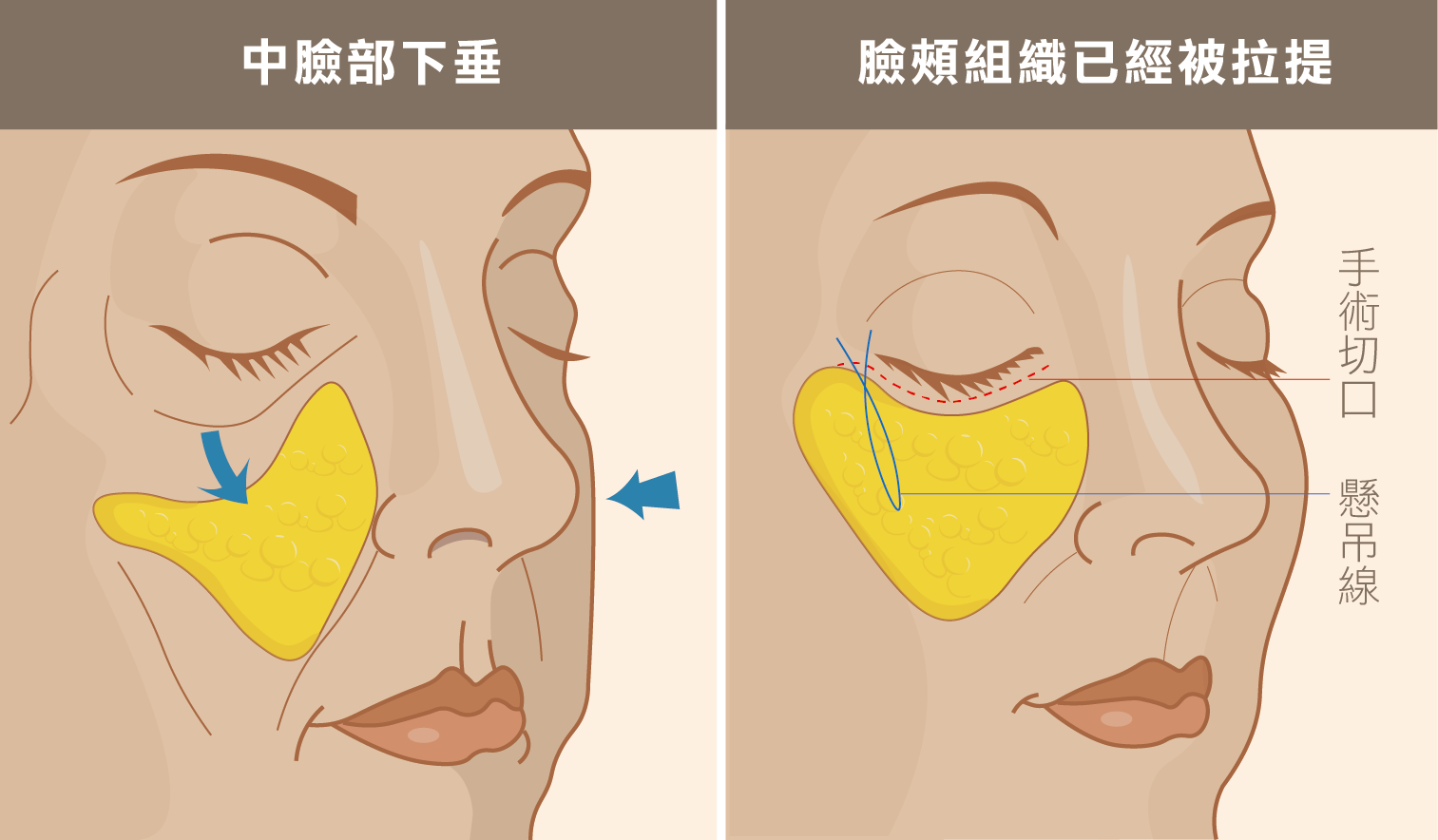 眼袋手術合併中臉拉提示意圖