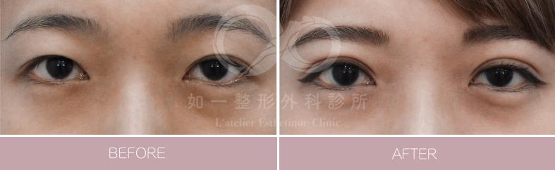 F8無痕縫雙眼皮手術
