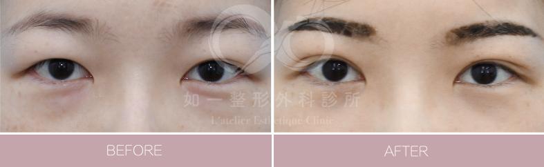 F8無痕縫雙眼皮手術