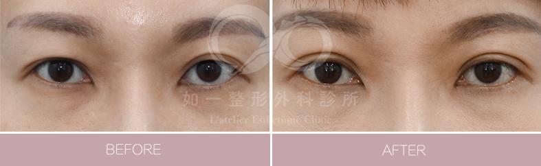 F8無痕縫雙眼皮手術