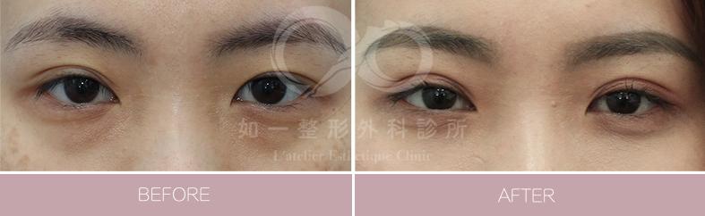 F8無痕縫雙眼皮手術