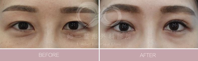 F8無痕縫雙眼皮手術
