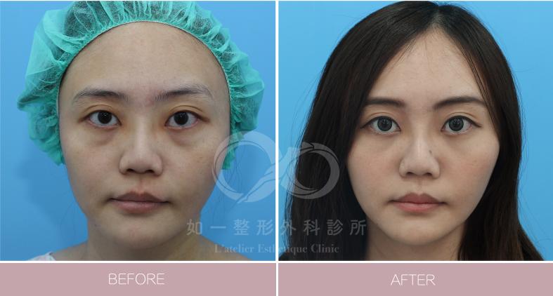 隱形眼袋移位手術