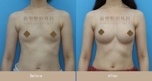 水滴隆乳