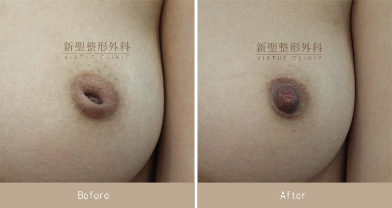 乳頭凹陷