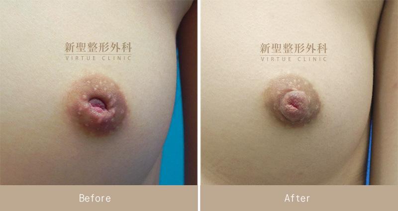 乳頭凹陷