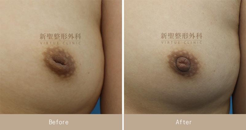乳頭凹陷