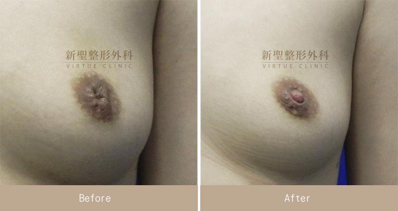 乳頭凹陷