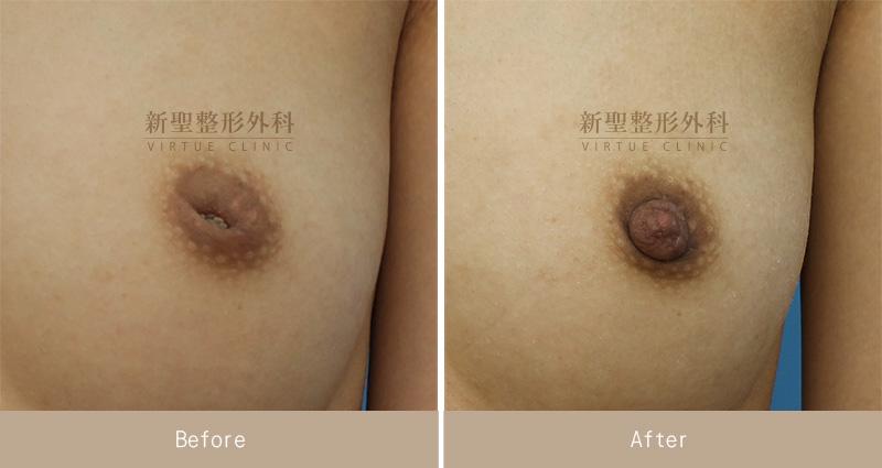 乳頭凹陷