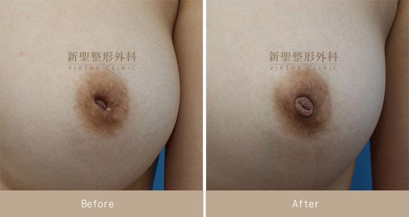 乳頭凹陷