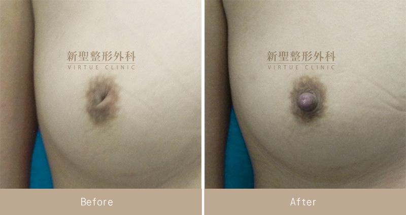 乳頭凹陷