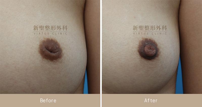 乳頭凹陷