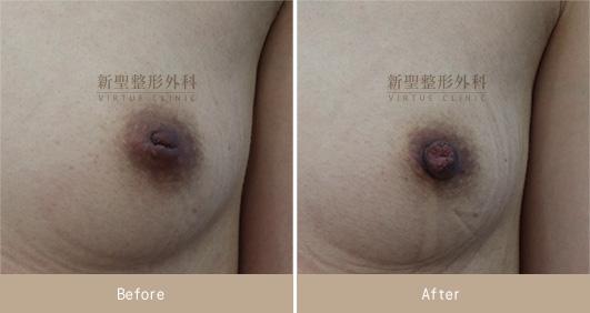 乳頭凹陷
