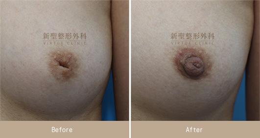 乳頭凹陷