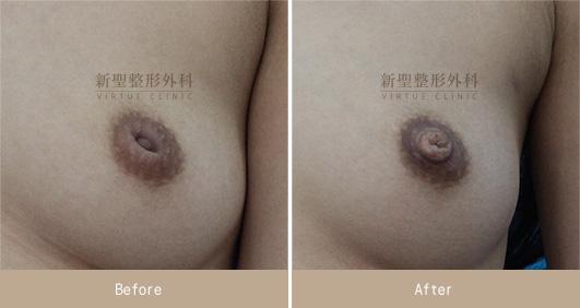 乳頭凹陷
