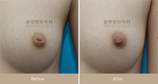 乳頭凹陷