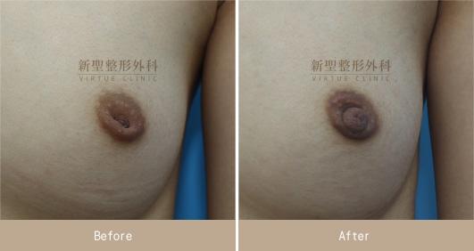 乳頭凹陷