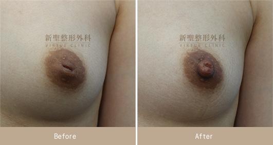 乳頭凹陷