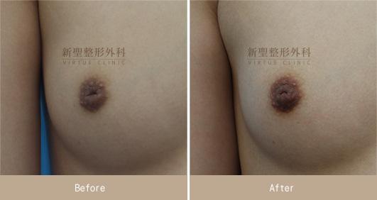 乳頭凹陷